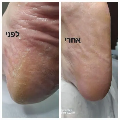 תיעוד טיפול מהקליניקה של הני קוסמטיקס